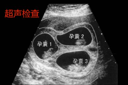 多胎妊娠图片