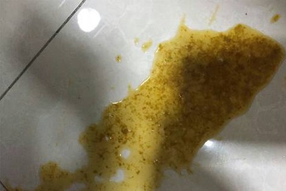 婴儿稀便和水样便区别图片 | 百度健康·医学科普