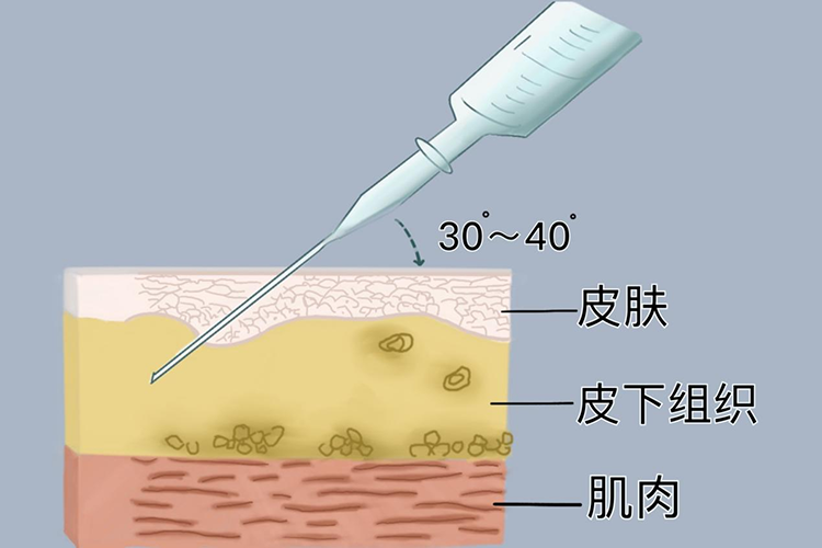 皮下注射大腿部 どこに打てばいい – 皮下注射 避ける部位 : 初めての皮下注射‐手順や注射部位について – OHMZAW