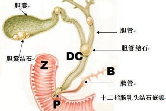哪些人容易胆管癌 | 百度健康·医学科普