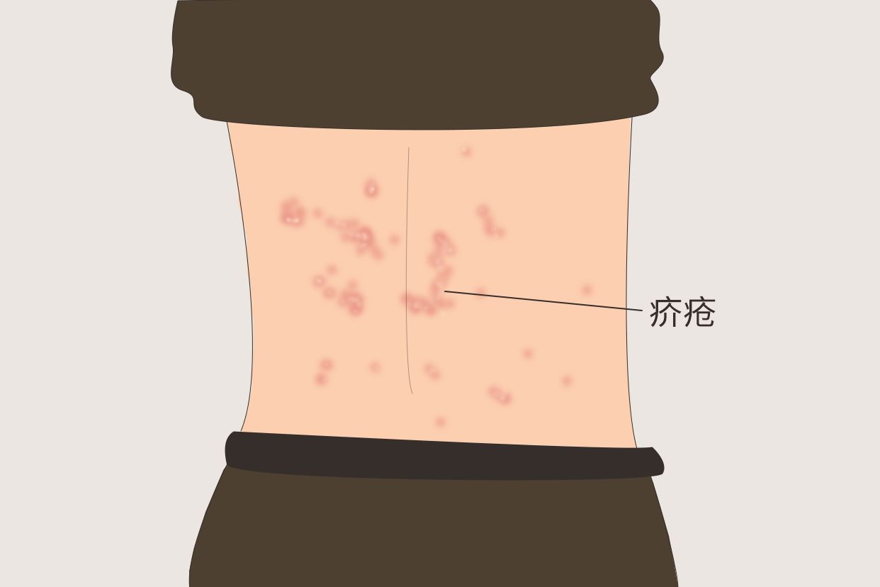 介疮长什么样子图片 | 百度健康·医学科普