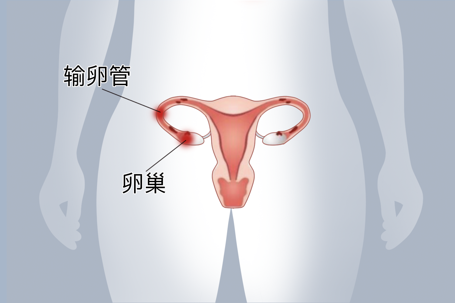 右侧输卵管、卵巢破裂疼痛位置图