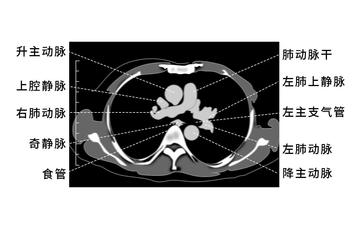 胸部ct血管影像解剖图谱