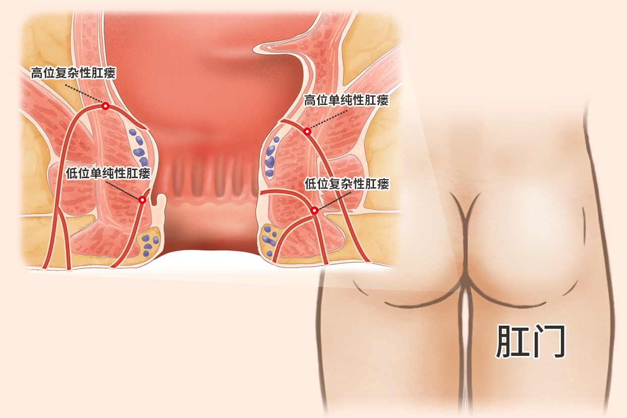 高位肛瘘图片