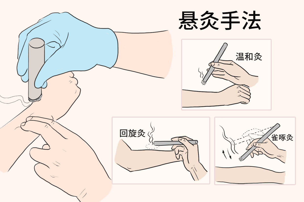 悬灸图片