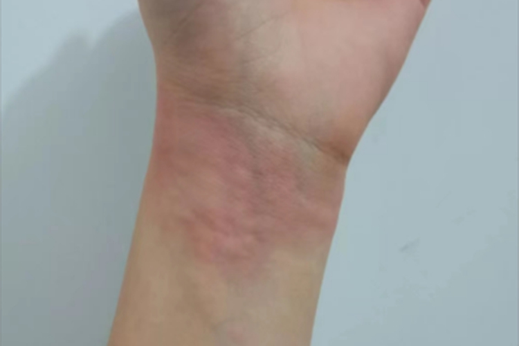 荨麻疹手腕风团图片