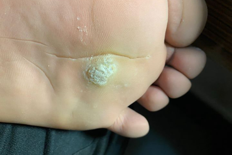 疣打针后脱落过程图解