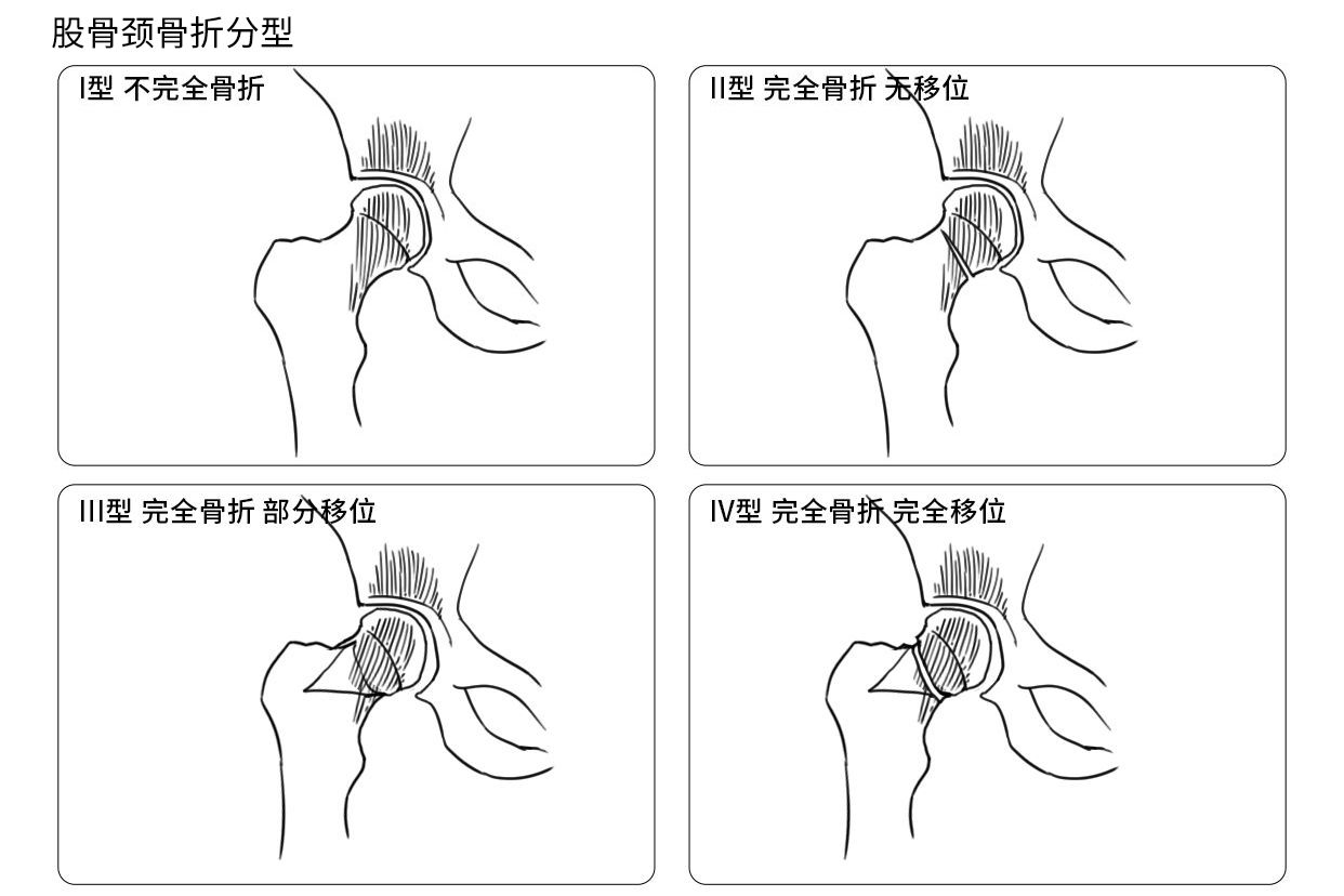 股骨颈骨折分型解剖图