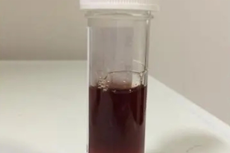 溶血现象图片