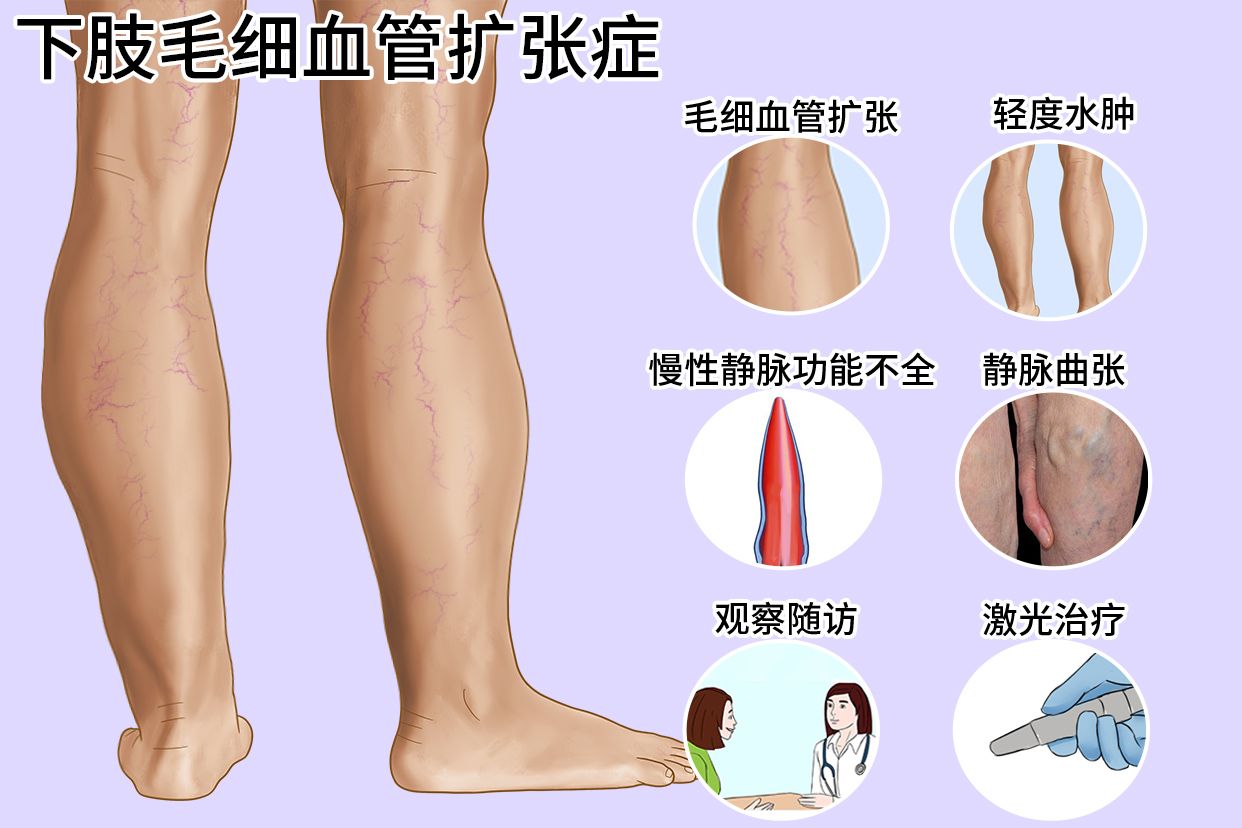 腿部毛细血管扩张症图片 | 百度健康·医学科普