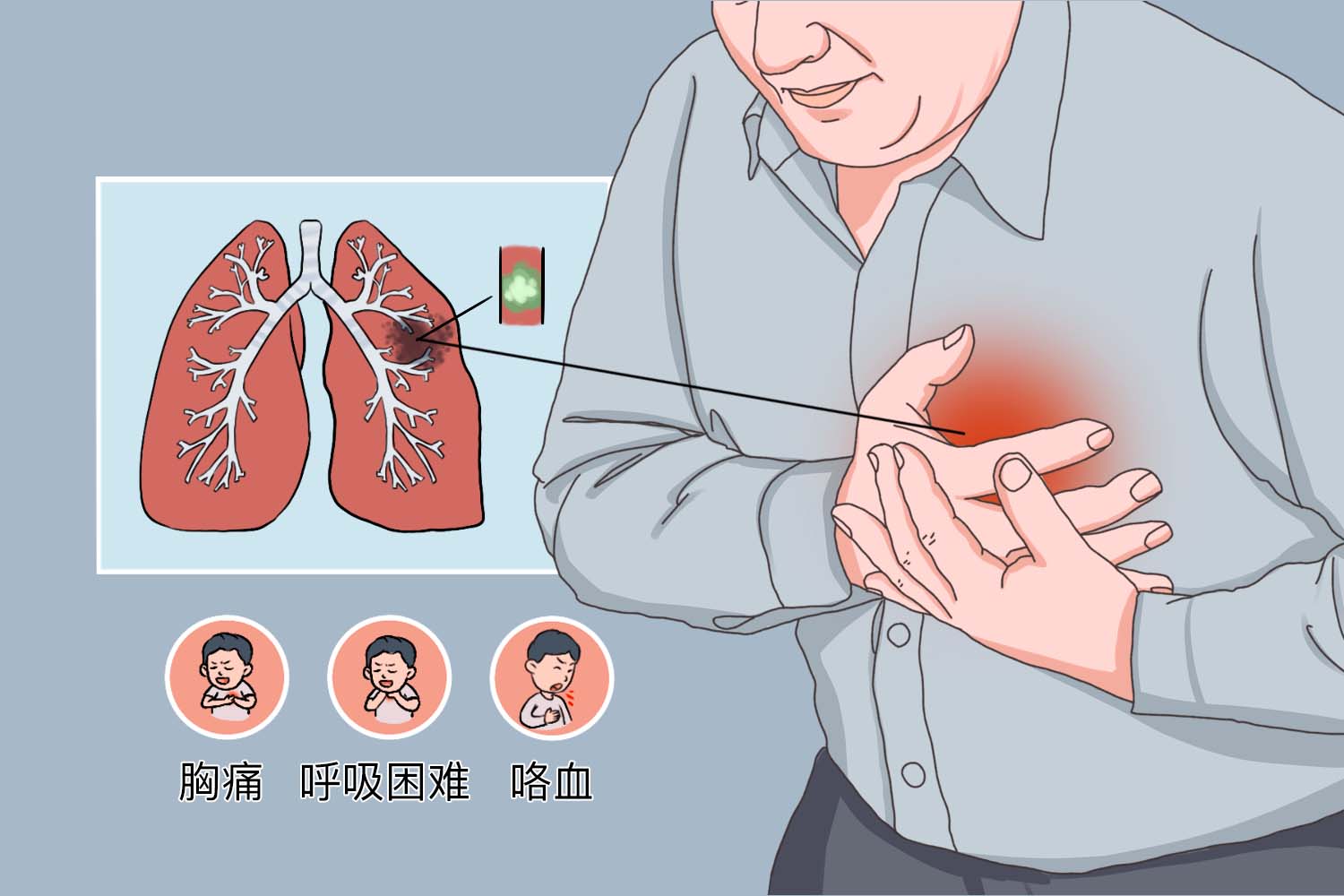 肺栓塞症状图