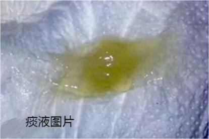 痰液图片