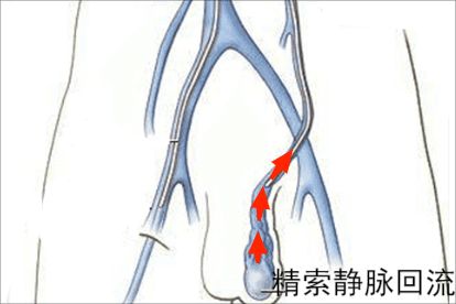 精索静脉回流示意图
