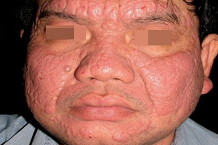 职业性光毒性接触性皮炎面红肿图