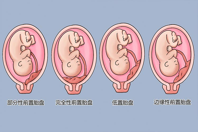 胎盘位置类型图