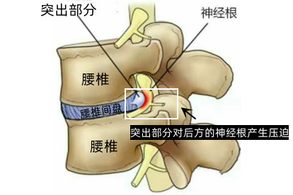 腰椎与神经根的关系图 | 百度健康·医学科普