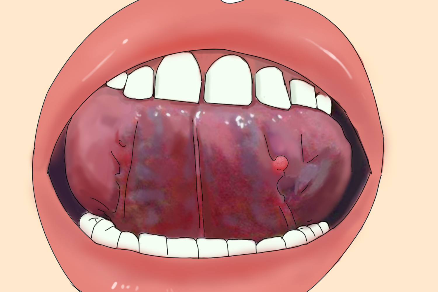 舌系带两侧有透明肉须有血丝图片