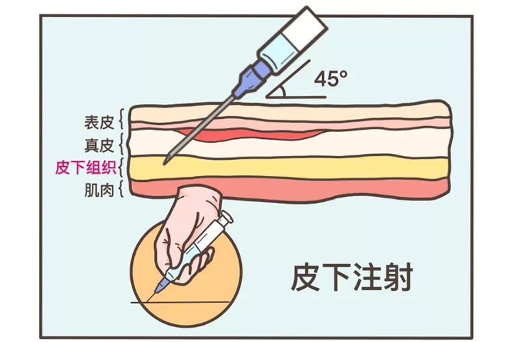 皮下,皮内,肌内注射的区别 | 百度健康·医学科普