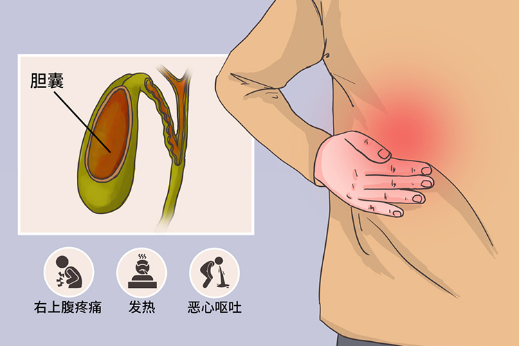 胆囊炎右上腹疼痛图