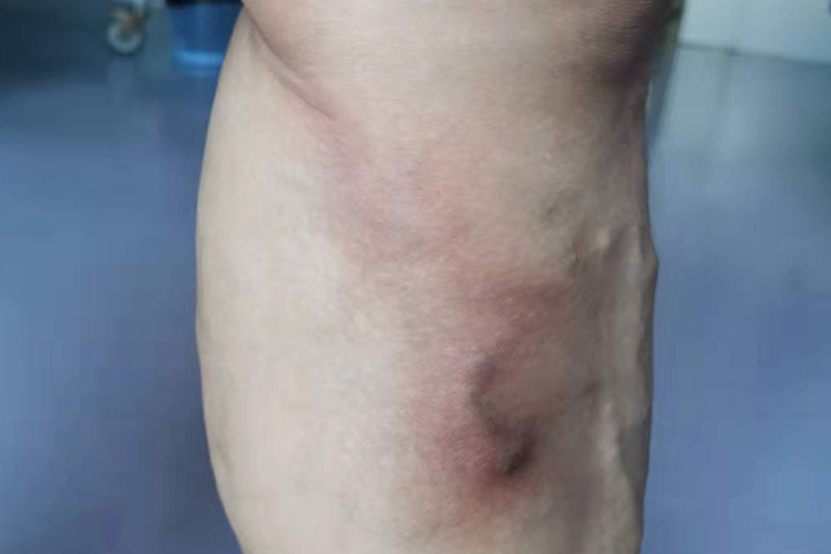静脉炎治疗