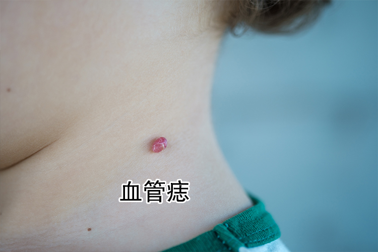 血点痣图片