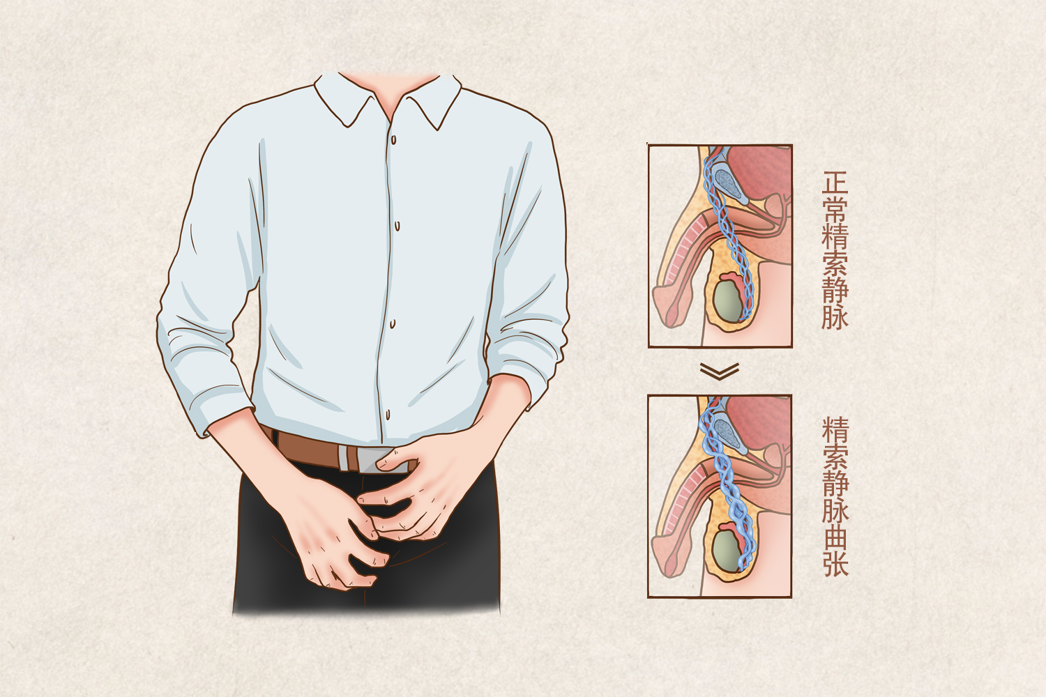 男性精索静脉曲张的症状图片