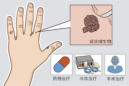 掌疣初期图片
