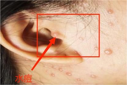 耳朵长泡疹图片 | 百度健康·医学科普