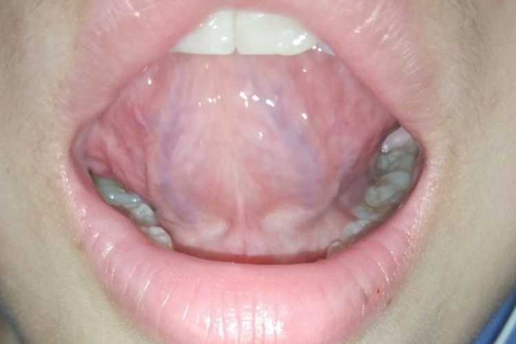 正常舌下络脉图