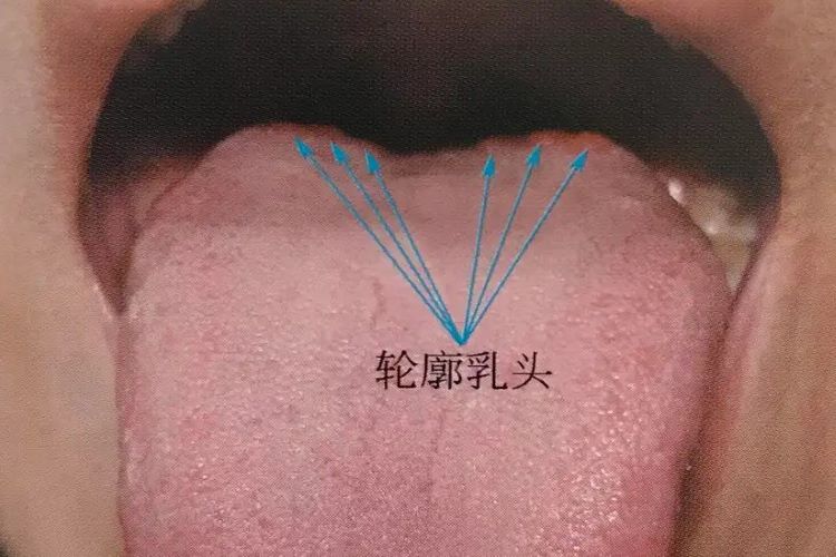 舌头两边有疙瘩图片 | 百度健康·医学科普