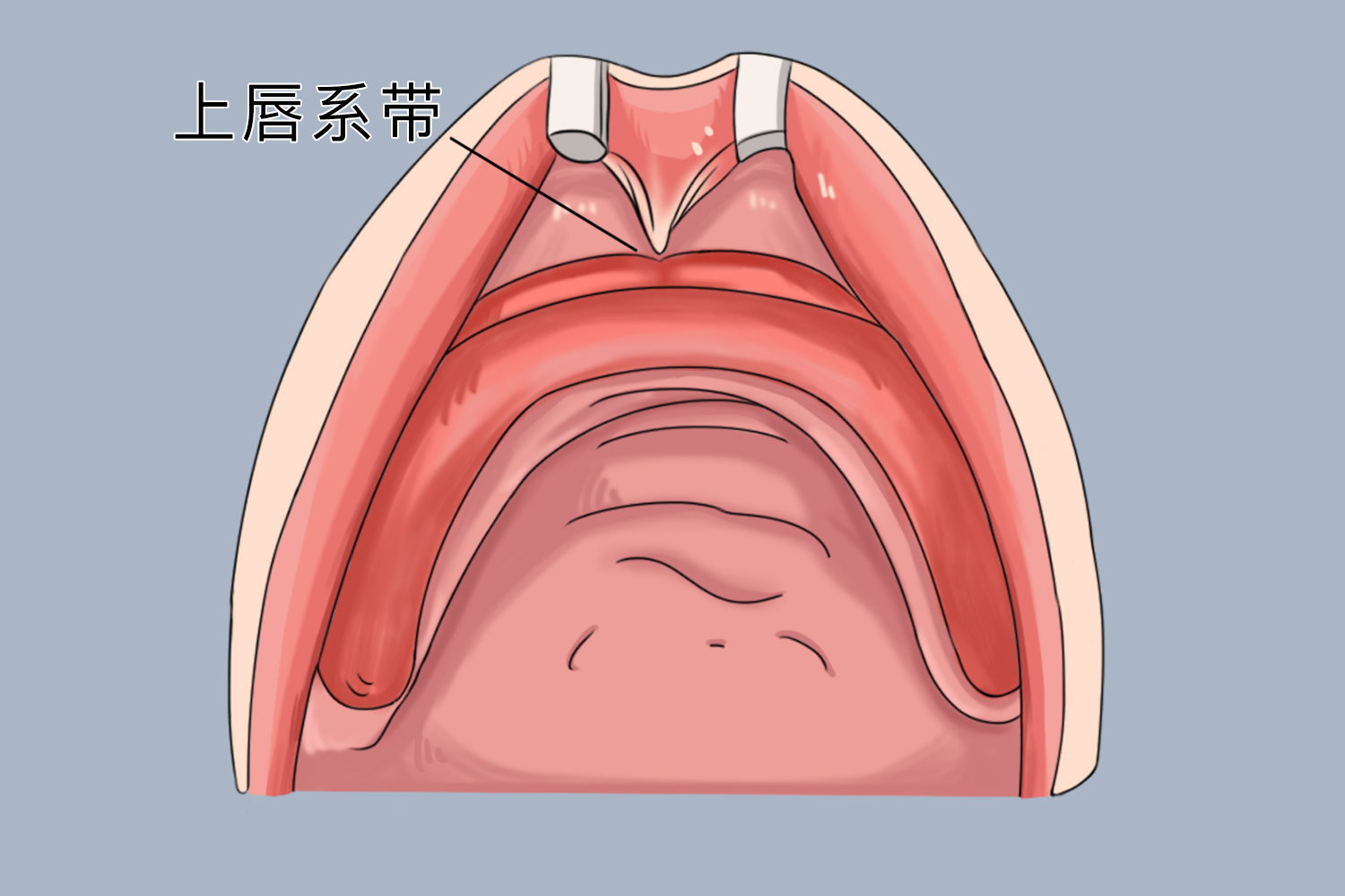 一岁半宝宝正常唇系带图
