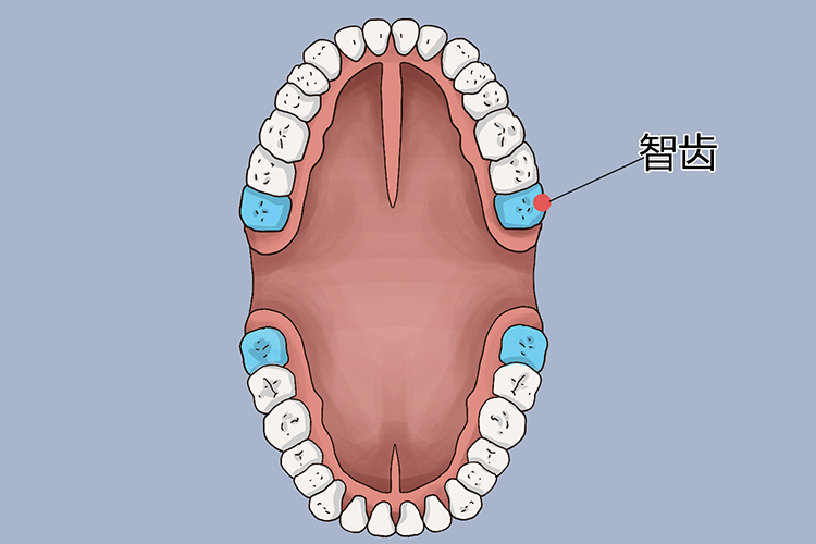 上下颌共四个智齿位置图