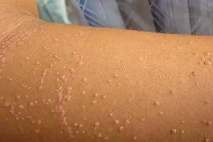 艾滋病小臂疙瘩图片