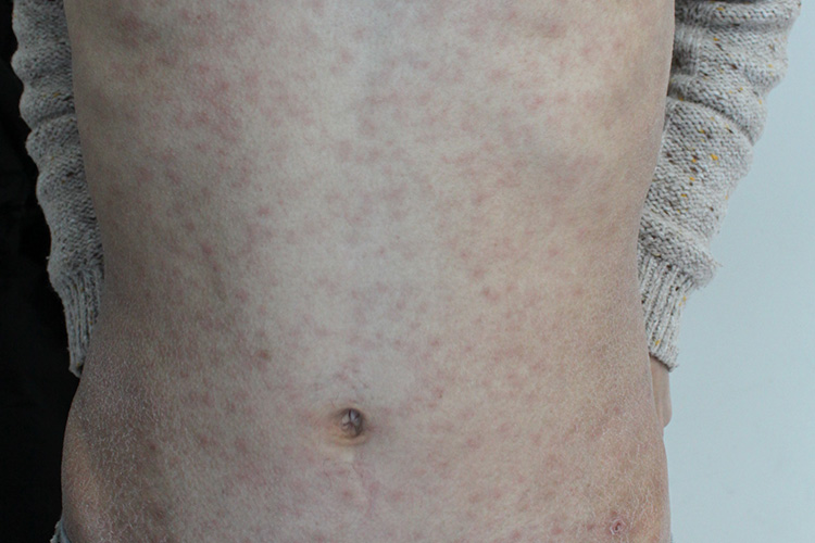 梅毒红疹腹部小红点图