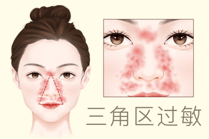 面部三角区过敏图片 | 百度健康·医学科普