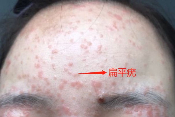 hpv感染初期红疹子图片 | 百度健康·医学科普
