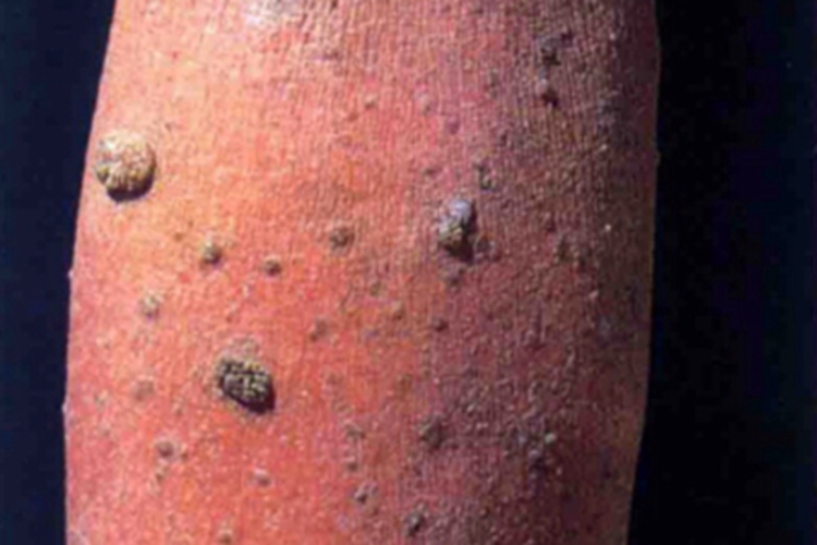 恶性黑棘皮病疙瘩图片