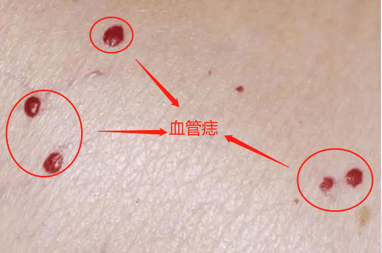 胸口有红色的小血点图