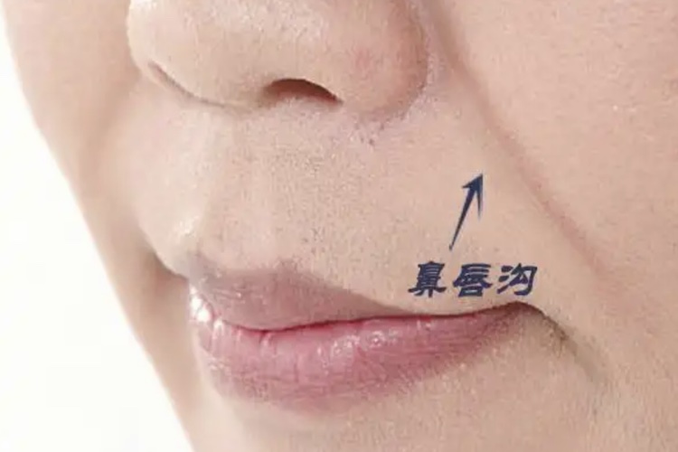 正常鼻唇沟图片