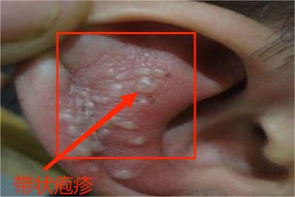 耳朵长泡疹图片 | 百度健康·医学科普