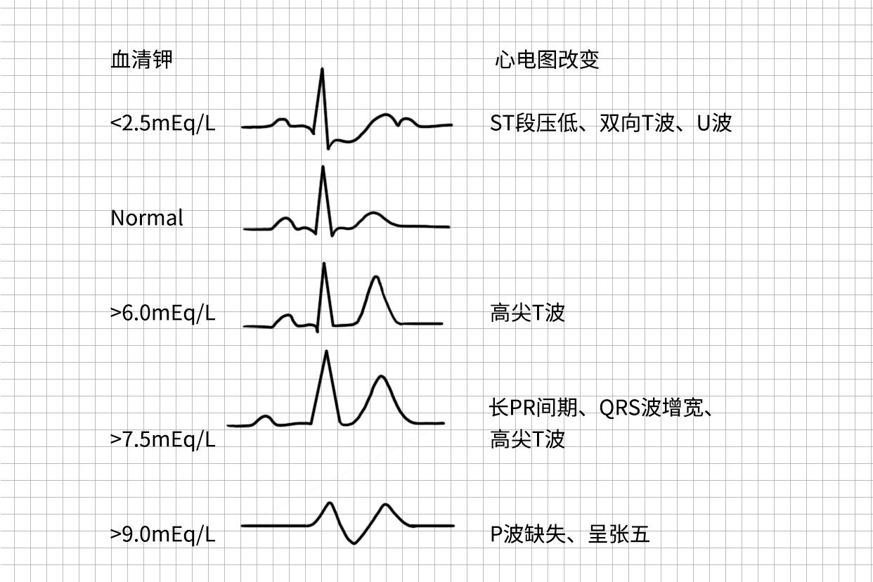 高钾血症T波高耸图片