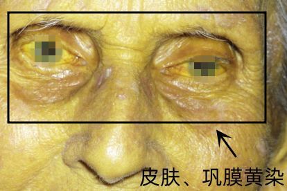 病理性黄疸症状及表现图片