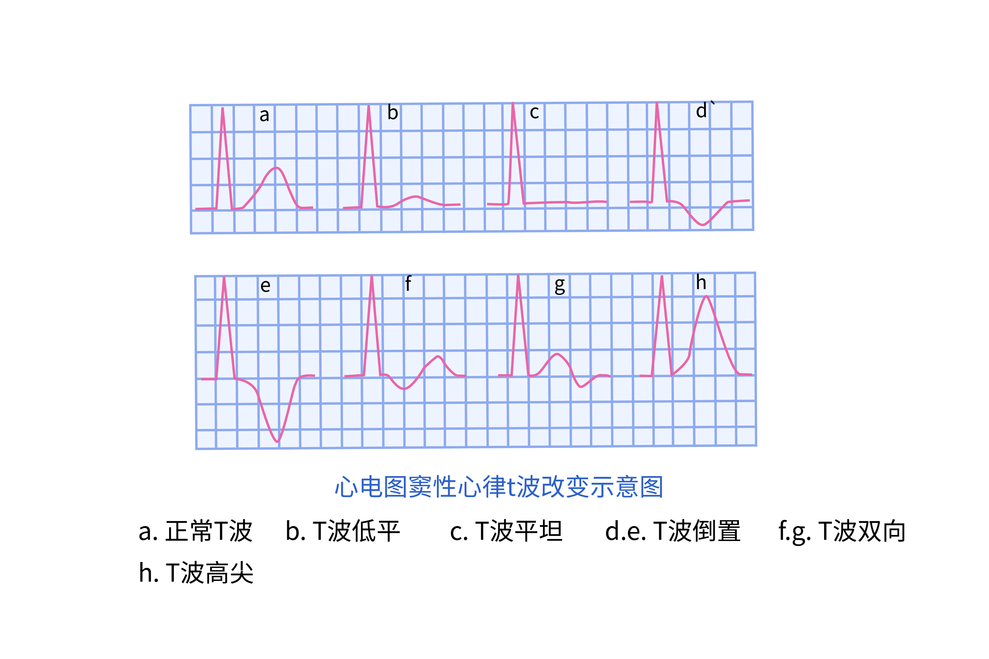 窦性心律心电图t波改变 | 百度健康·医学科普