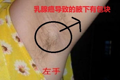 腋下包块癌症图片