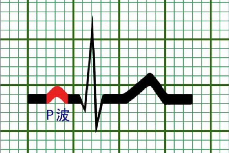 心电图P波代表什么
