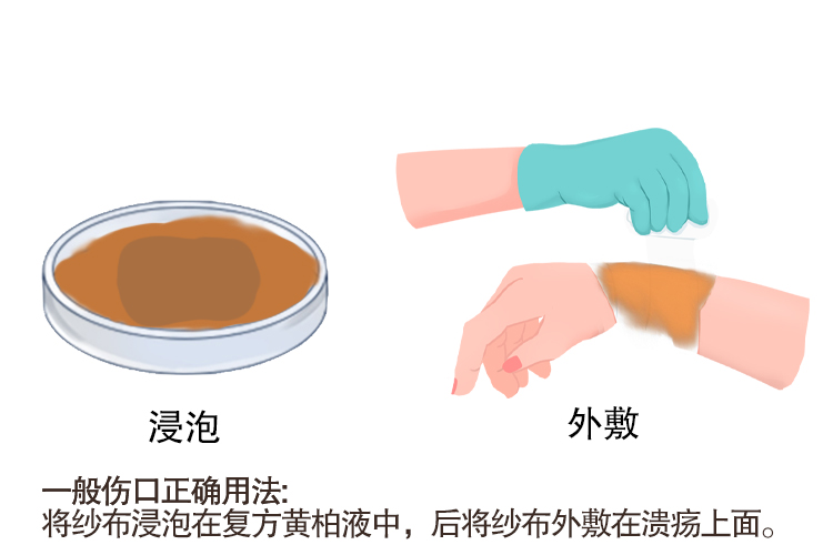 复方黄柏液涂剂正确用法图解 | 百度健康·医学科普