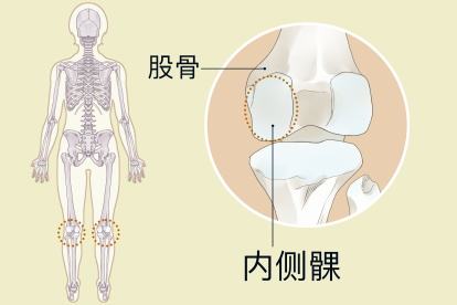 股骨内侧髁位置图片