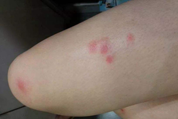 成人痒疹大腿红斑图片