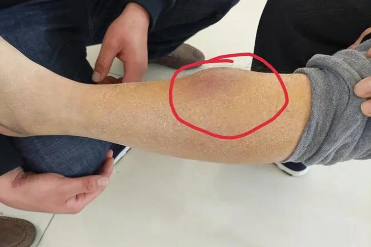 腿上长囊肿图片