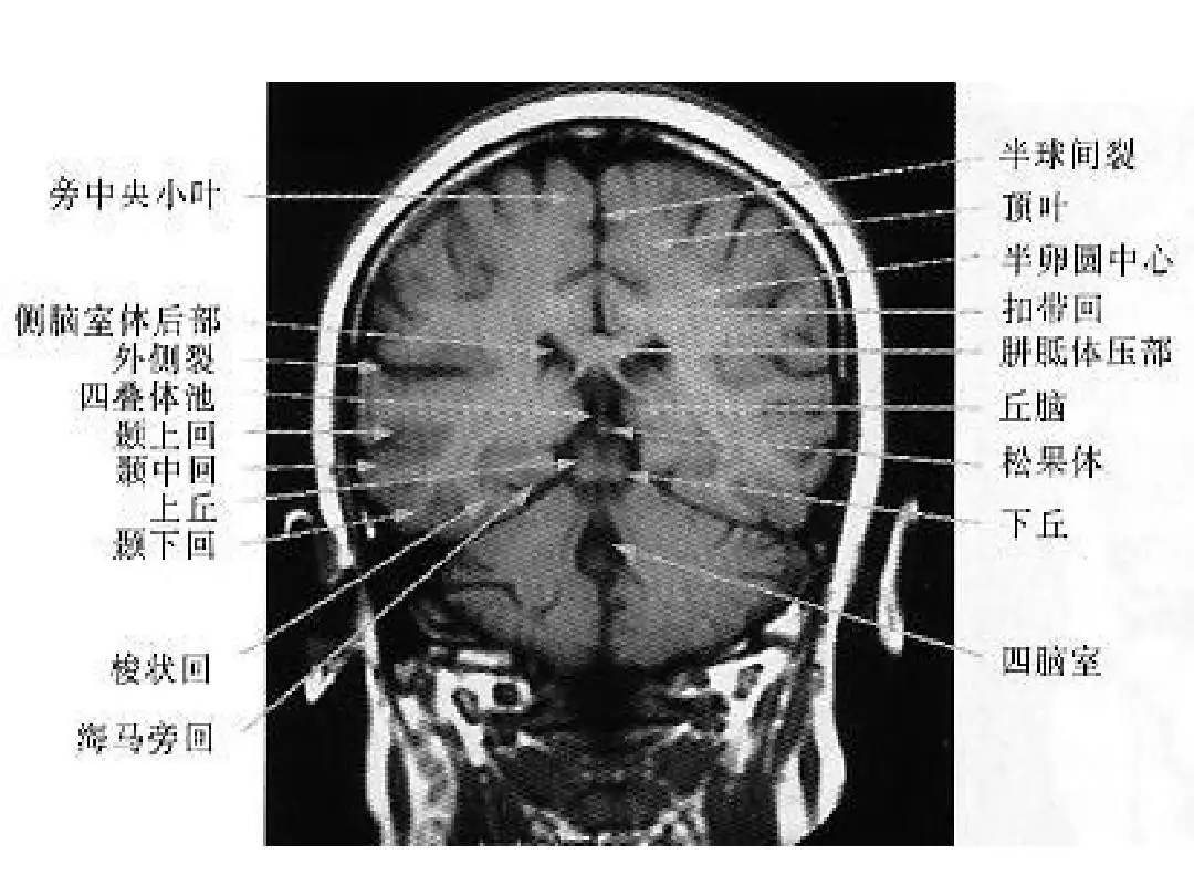 新手看脑部ct片图解